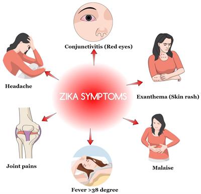 Zika Virus Infection during Pregnancy and Congenital Abnormalities